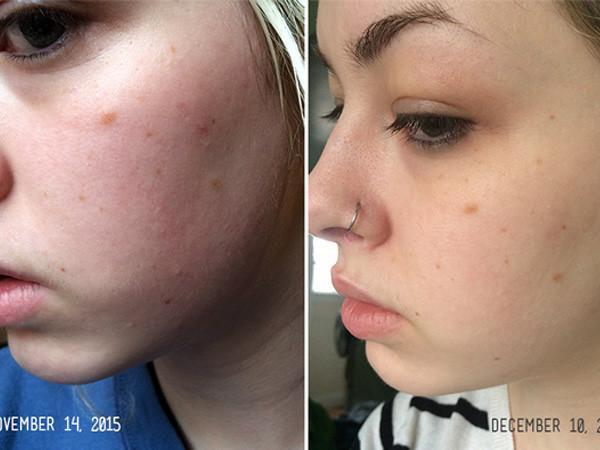 My darling clementine is showing before and after using our organic skincare products
